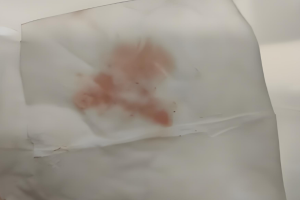 移植后出血可能是胚胎正在着床