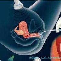 女人第三次流产泰国试管几代比建议_泰国三代试管生孩子成功率！