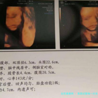 泰国试管做一对多胎胎需要多少钱