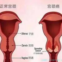 发炎会传染不孕不育吗（发炎会传染不孕不育吗男性）