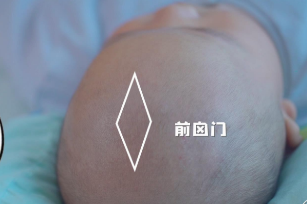 囟门闭合过慢可能是某种疾病