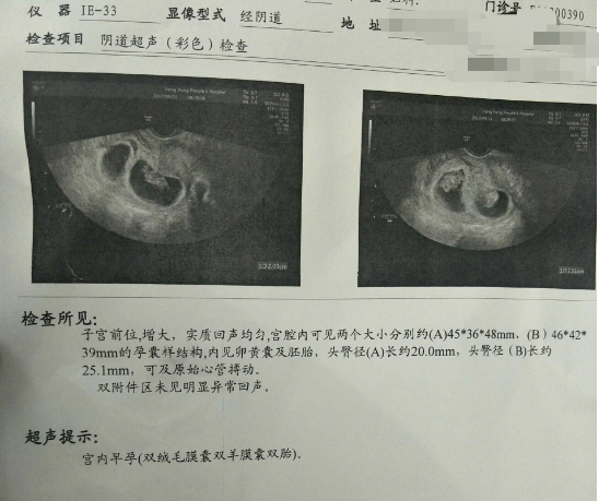 孕囊形状跟胎儿助孕无关