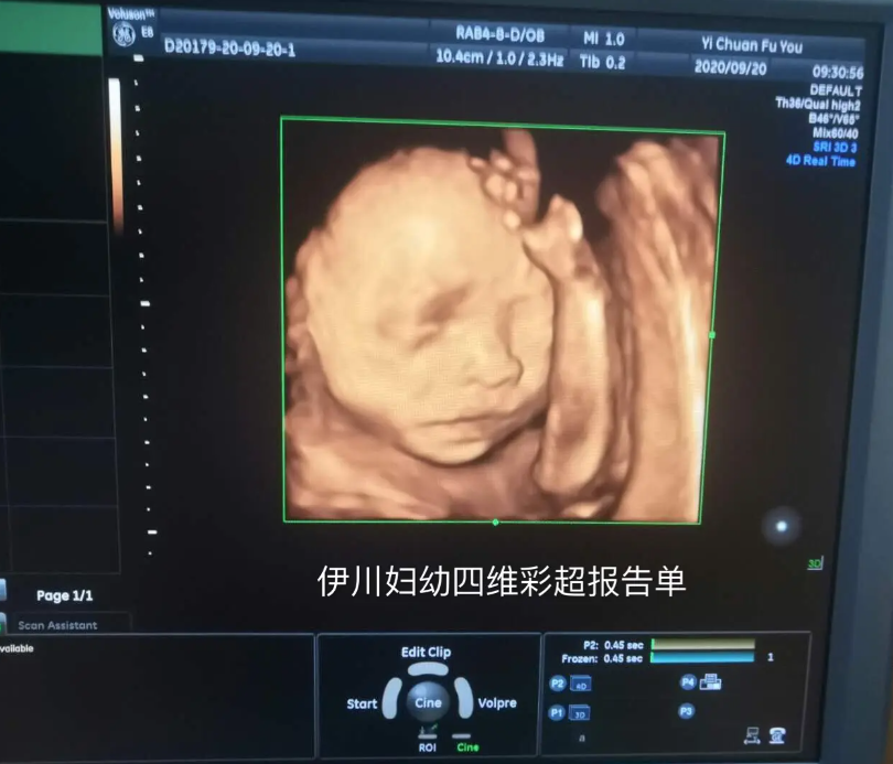 胎儿体位的关系会导致四维检查助孕翻盘
