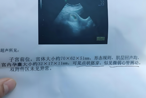 孕囊直径异常可能是胎停了