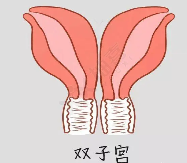 造成的双子宫的原因