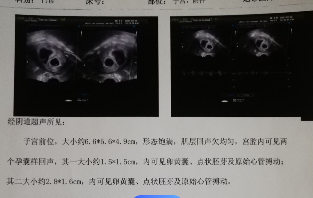 胚胎质量会影响试管一超的结果