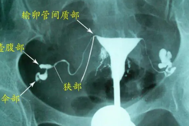 输卵管结果正常一个月后可以做试管