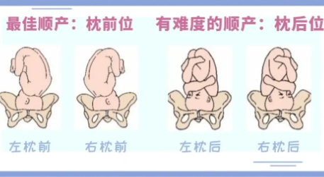 枕前位最适合顺产