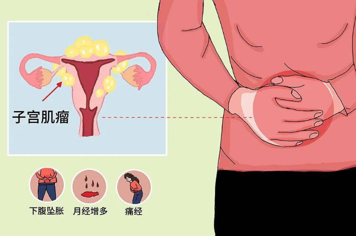 子宫肌瘤会出现褐色分泌物