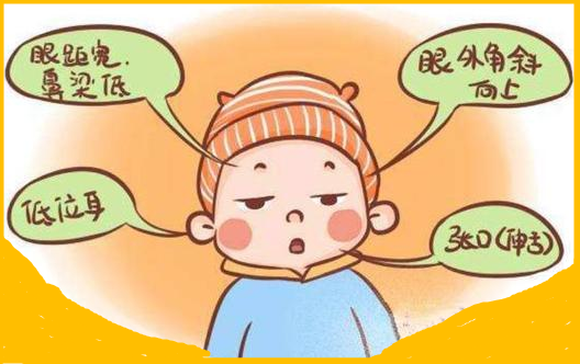 唐氏儿面部特征明显