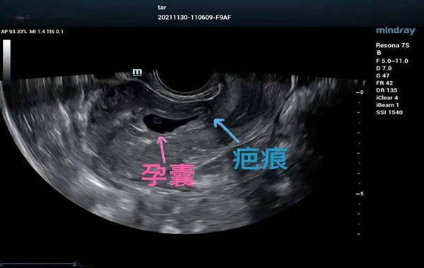 孕囊离切口疤痕近不建议要孩子