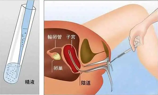 人工受精的全過程解析