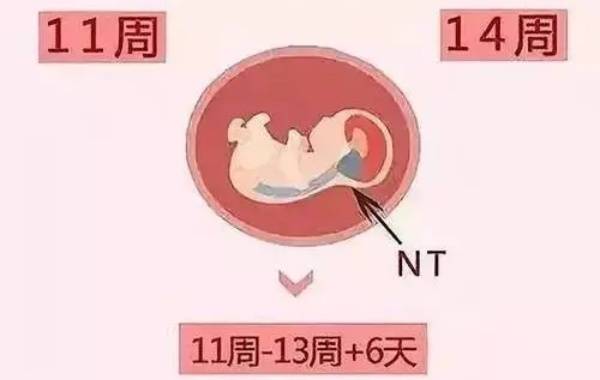 nt值高通常与染色体异常有关