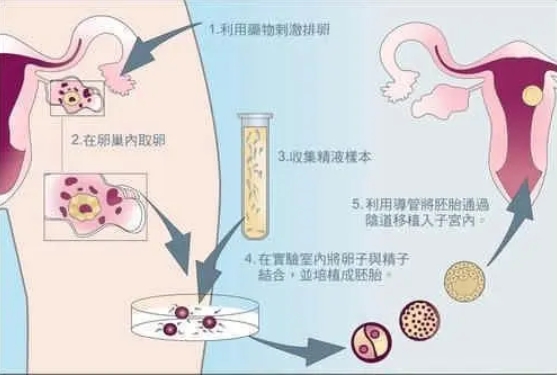 海外做試管需12萬