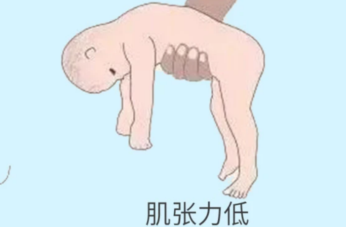 唐氏儿肌肉张力较低