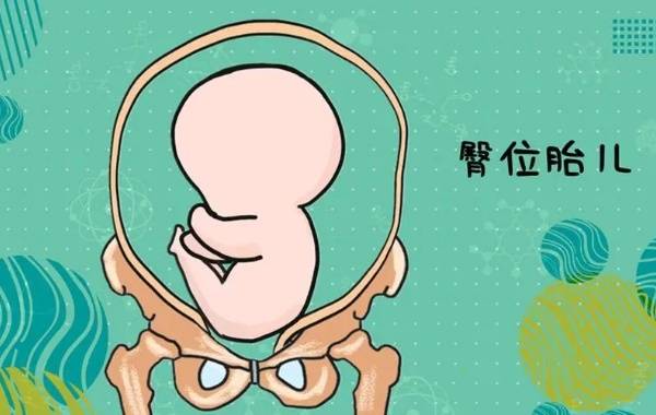 臀位的孩子不能判断孩子多还是女孩多