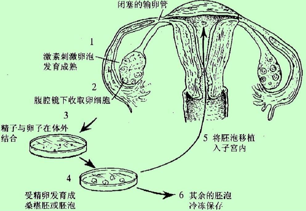 體外受精的流程圖