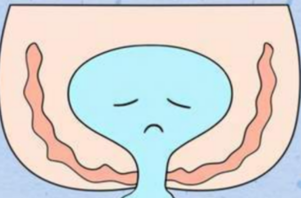 盆底肌修复期间保持阴部卫生