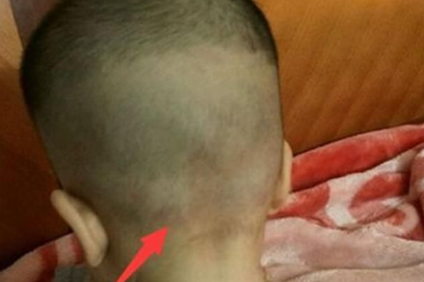 脱水会导致囟门凸起