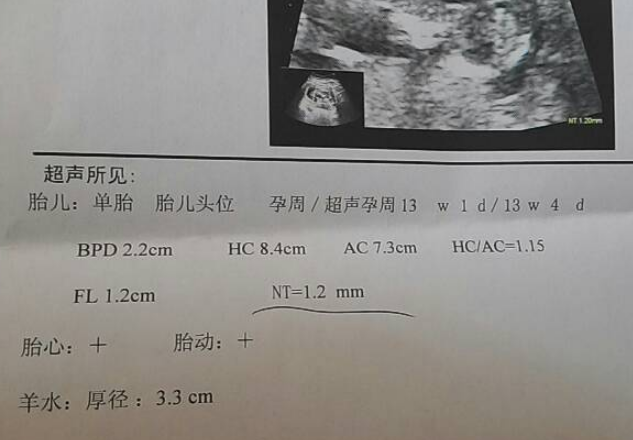 孕13周做孕检nt值重要还是鼻骨这项指标重要？