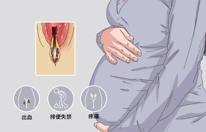 三度会阴撕裂伤口较长且深