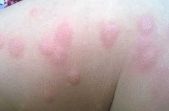 导致荨麻疹的过敏源多种多样