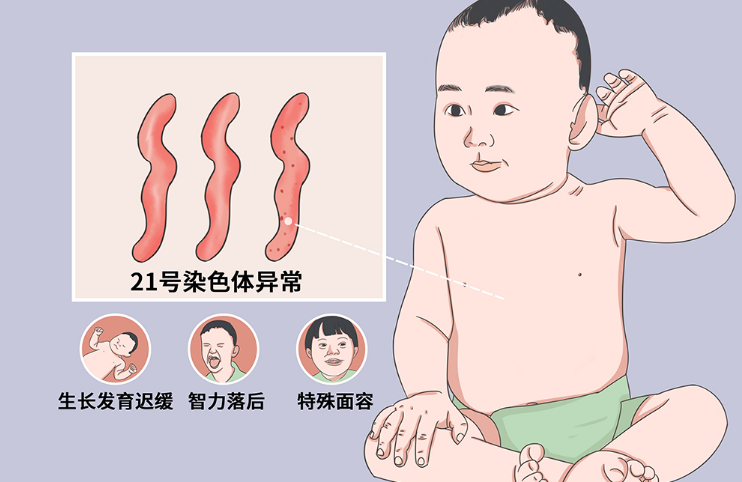 唐氏儿智力发育迟缓